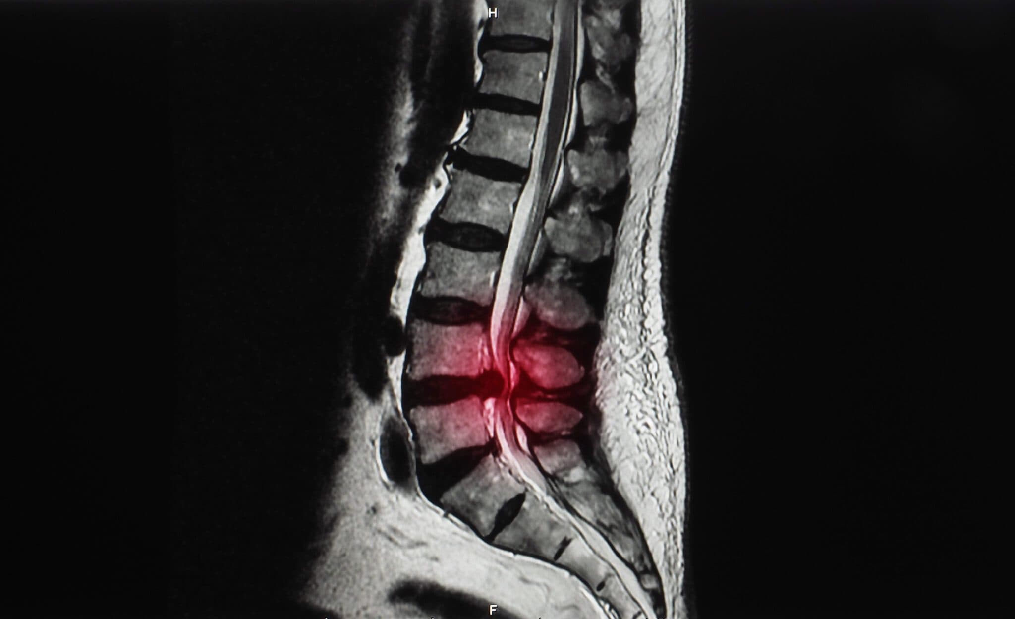 Illustration of a spinal disc bulge and herniation